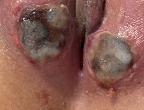 Genital Ulcer
